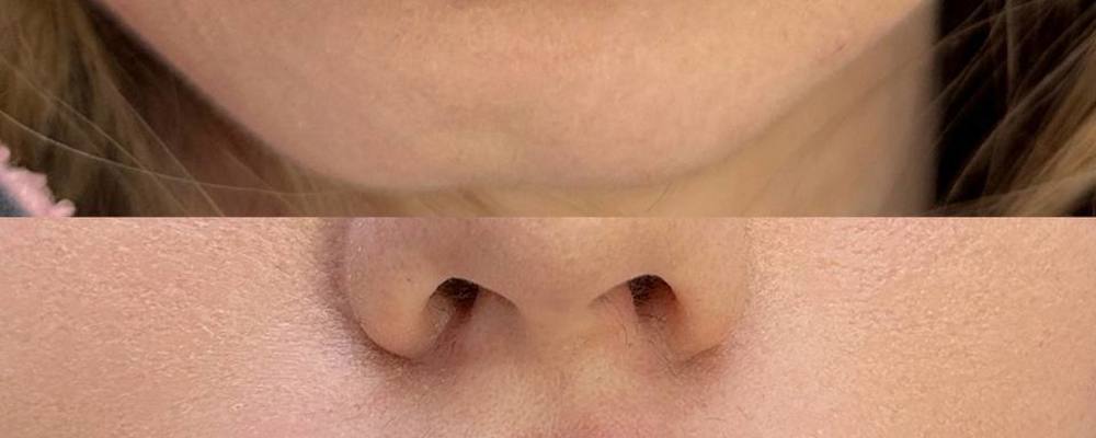 Увеличение губ