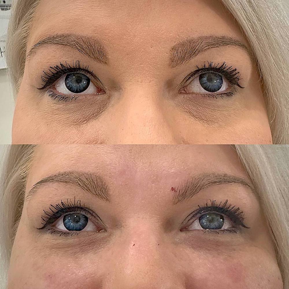 Заполнение носослезной борозды