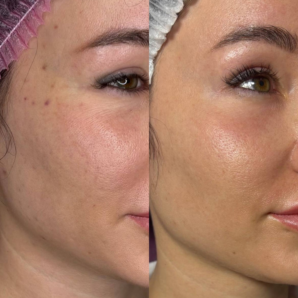 Комплексное омоложение