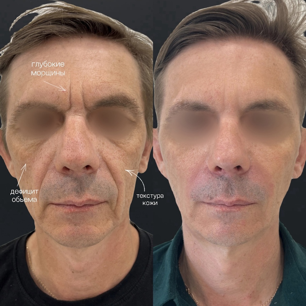 Комплексное омоложение лица