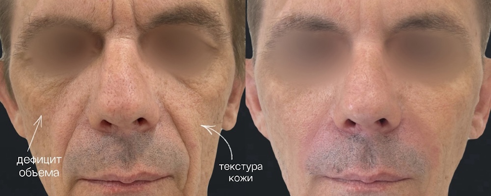 Комплексное омоложение лица