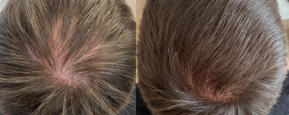 Плазмотерапия волосистой части головы