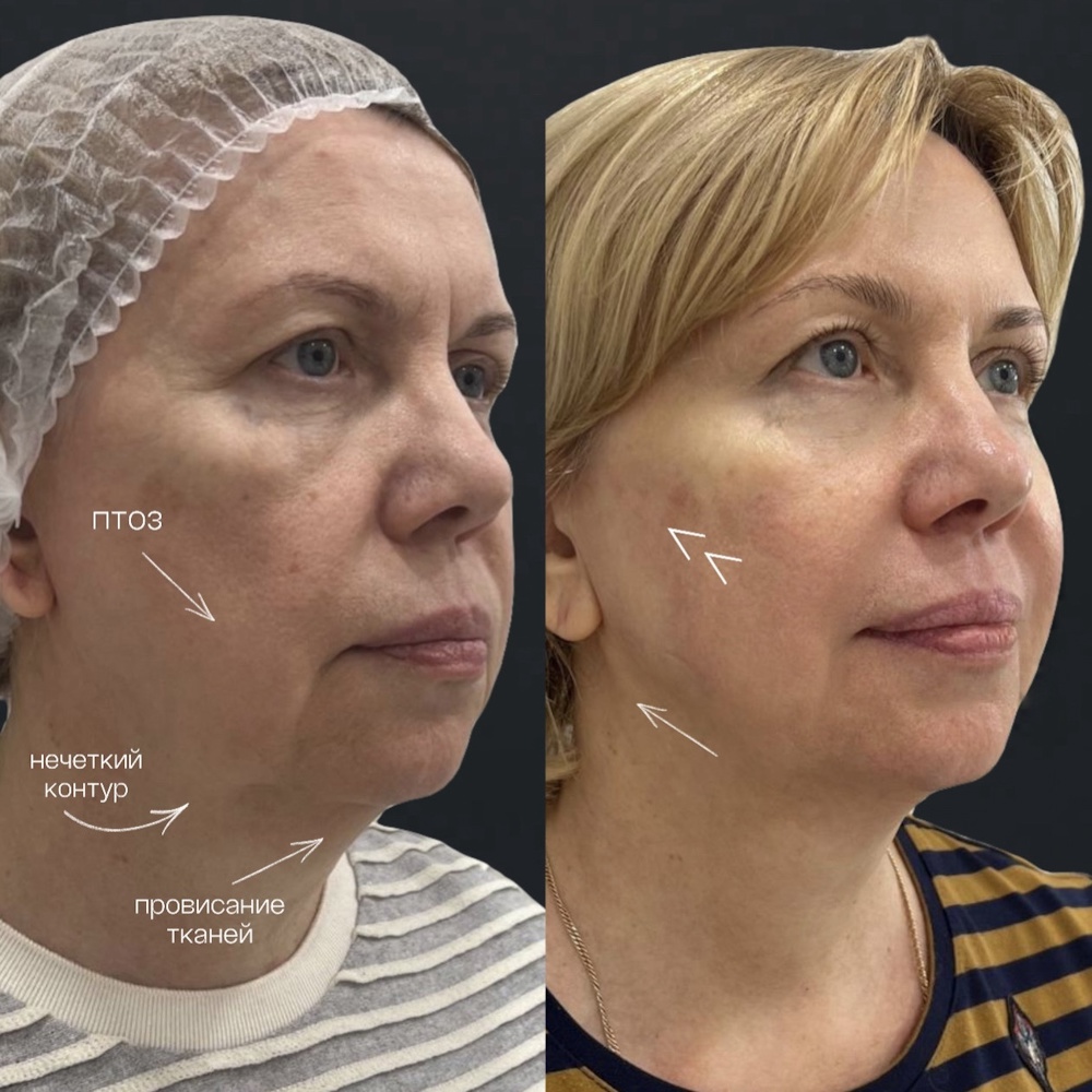 Безоперационная подтяжка Endolift