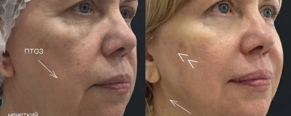 Безоперационная подтяжка Endolift