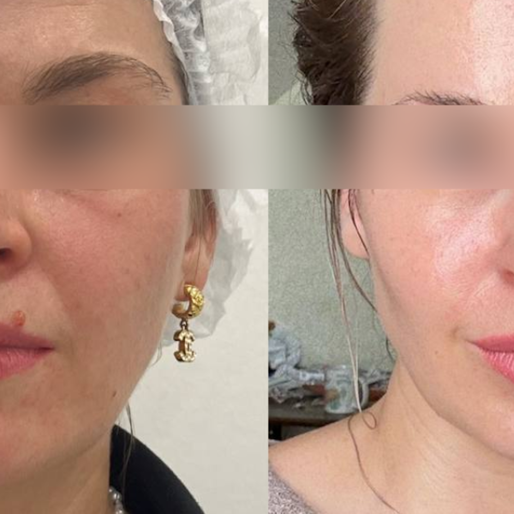 Комплексное омоложение