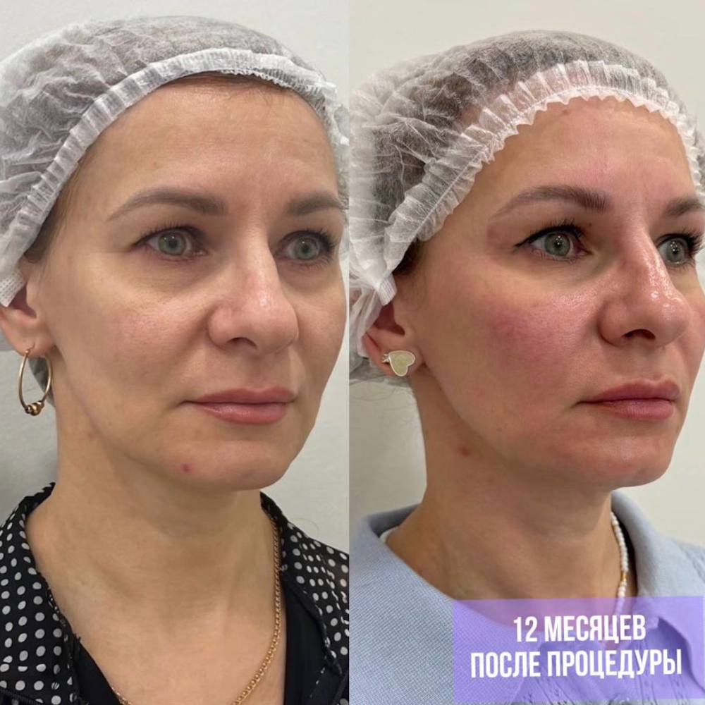 Лазерный лифтинг Endolift