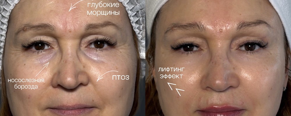 Комплексная коррекция лица