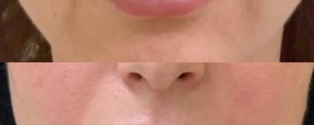 Комплексное омоложение