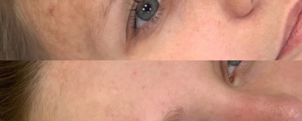 Коррекция пигментации