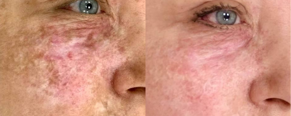 Коррекция гиперпигментации