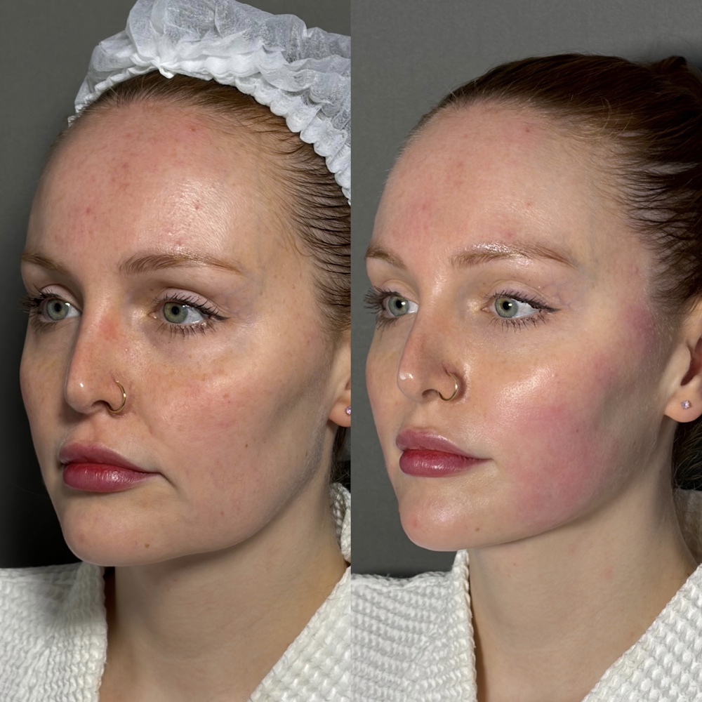 SMAS-лифтинг лица Ultraformer MPT