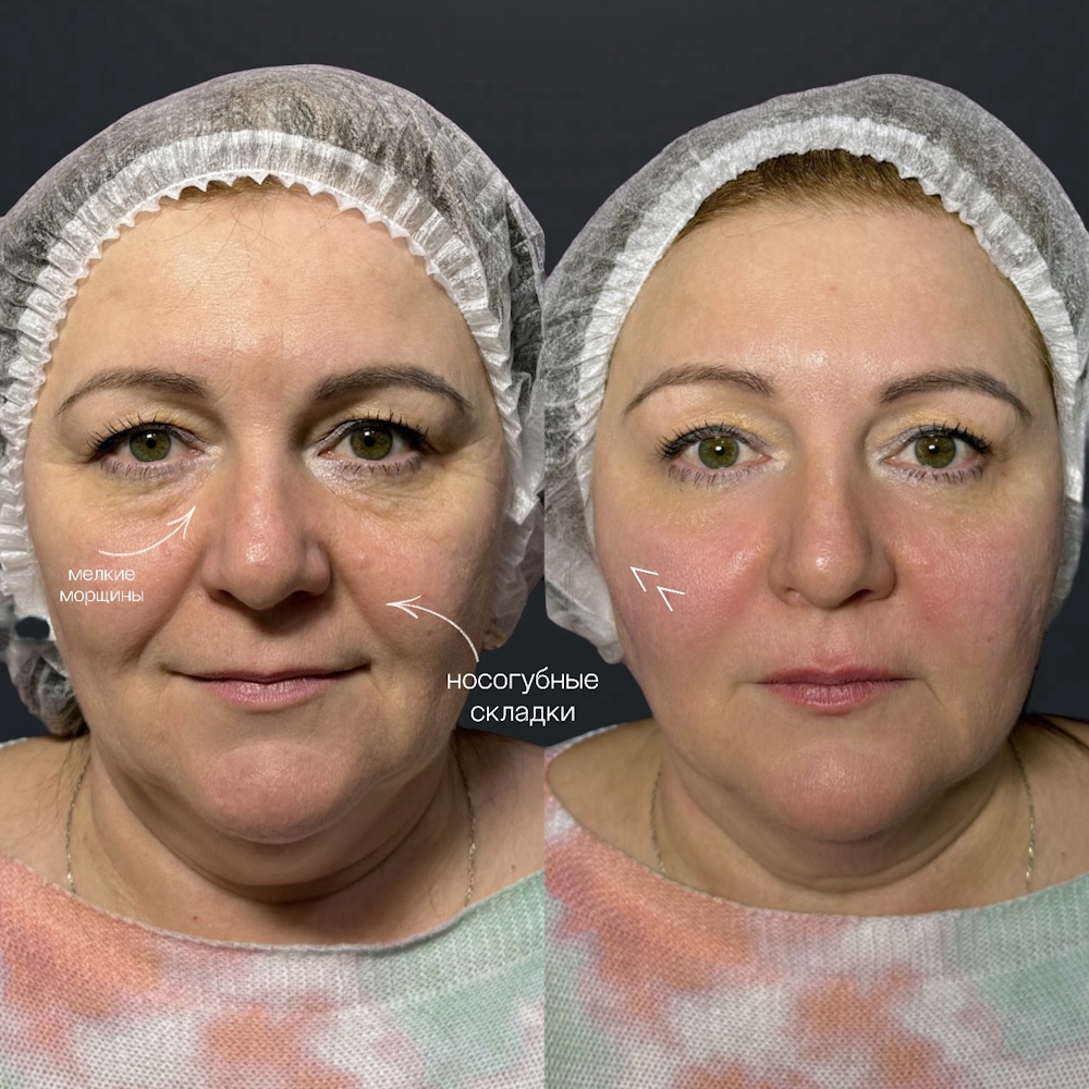 Контурная пластика средней трети