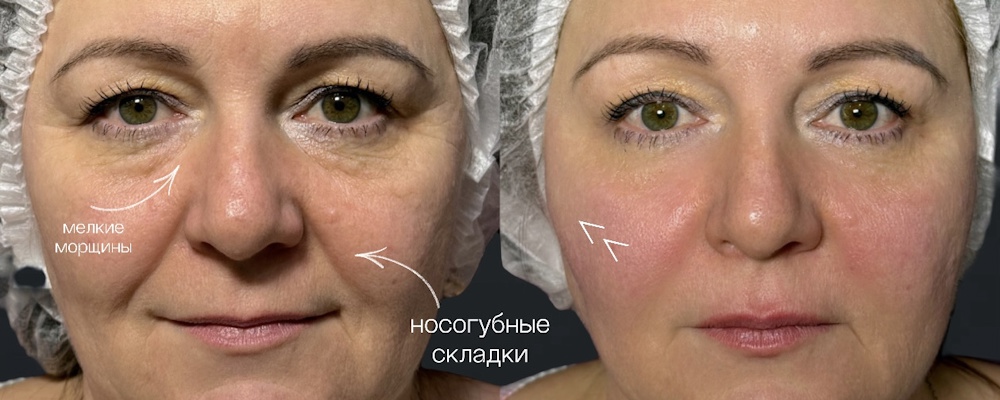 Контурная пластика средней трети