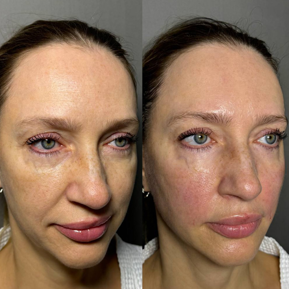 Smas-lifting на аппарате Ultraformer MPT