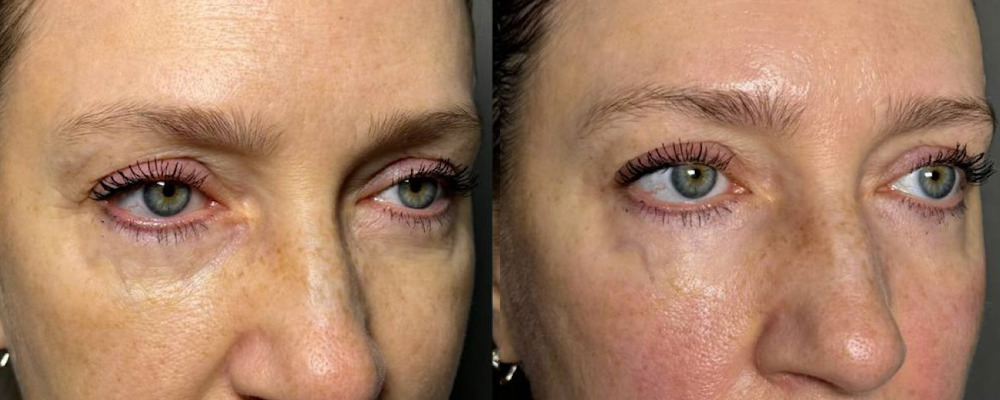 Smas-lifting на аппарате Ultraformer MPT