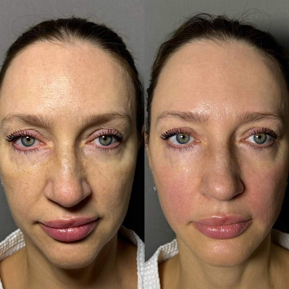 Smas-lifting на аппарате Ultraformer MPT