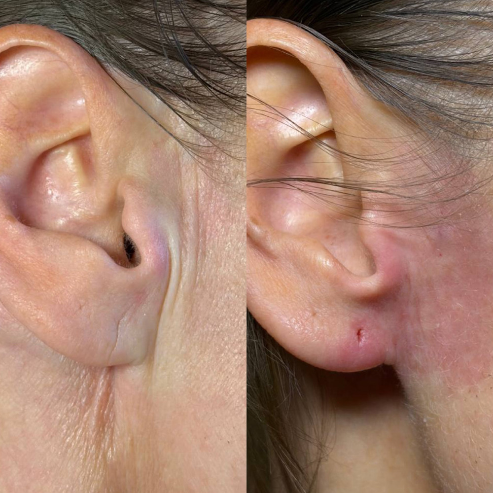 Контурная пластика ушей 