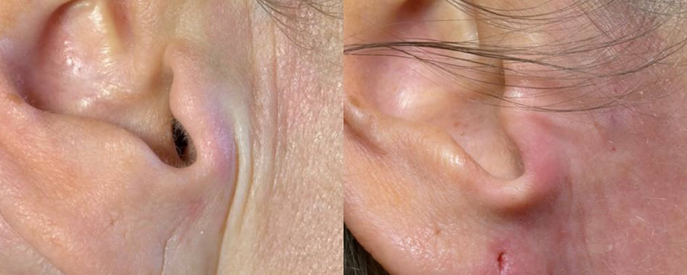 Контурная пластика ушей 