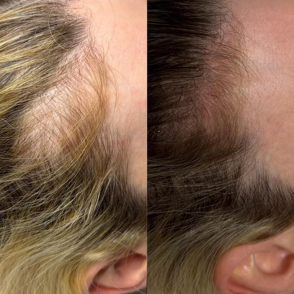 Лечение выпадения волос