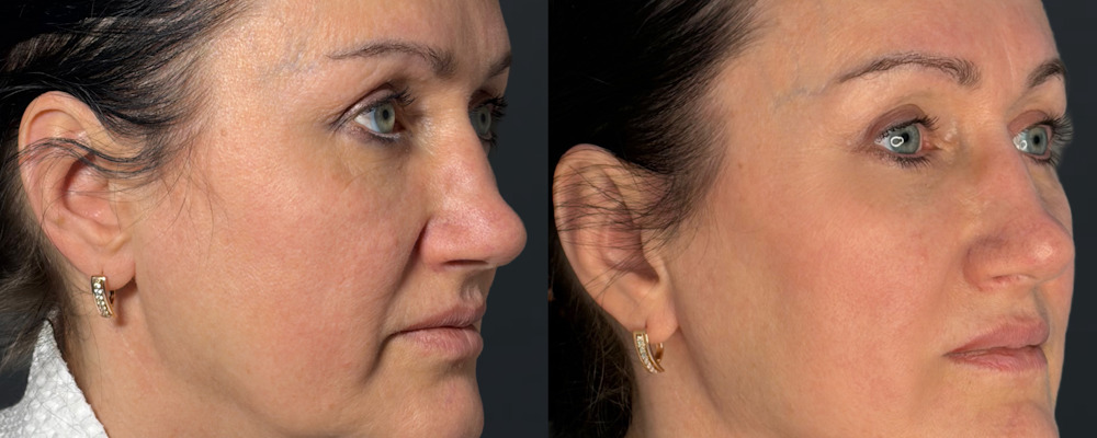 Комплексная коррекция лица