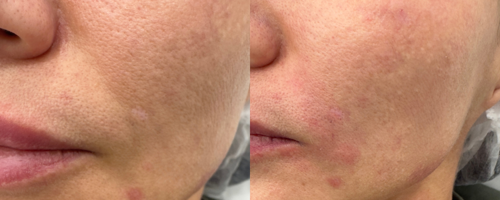 Коррекция носогубных складок