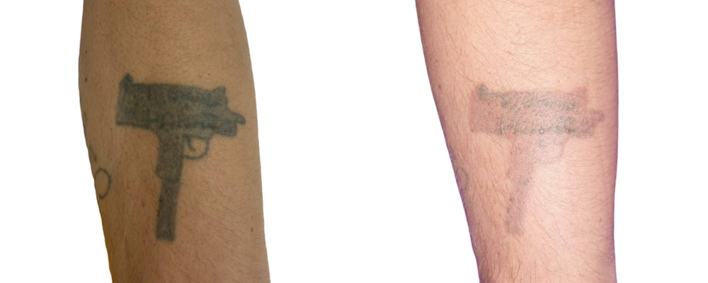 Ru:  Удаление татуировки