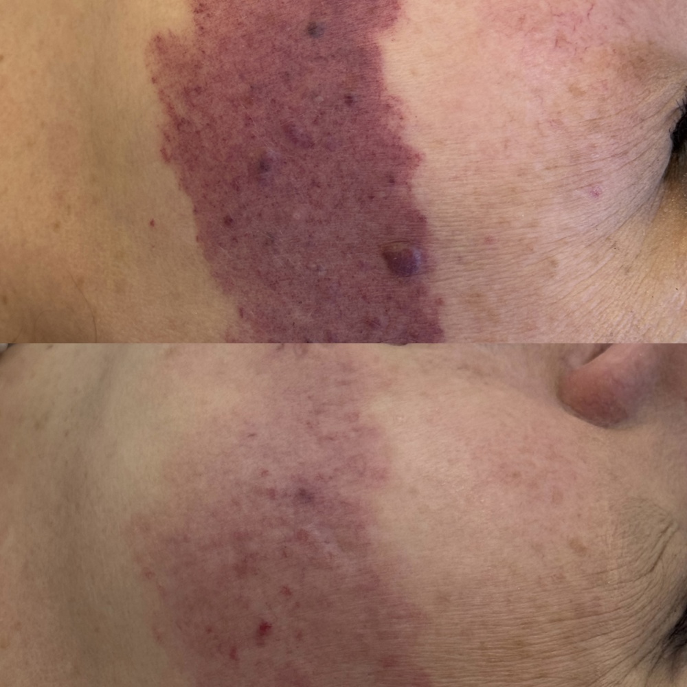 Комплексная коррекция врожденного «винного пятна» 