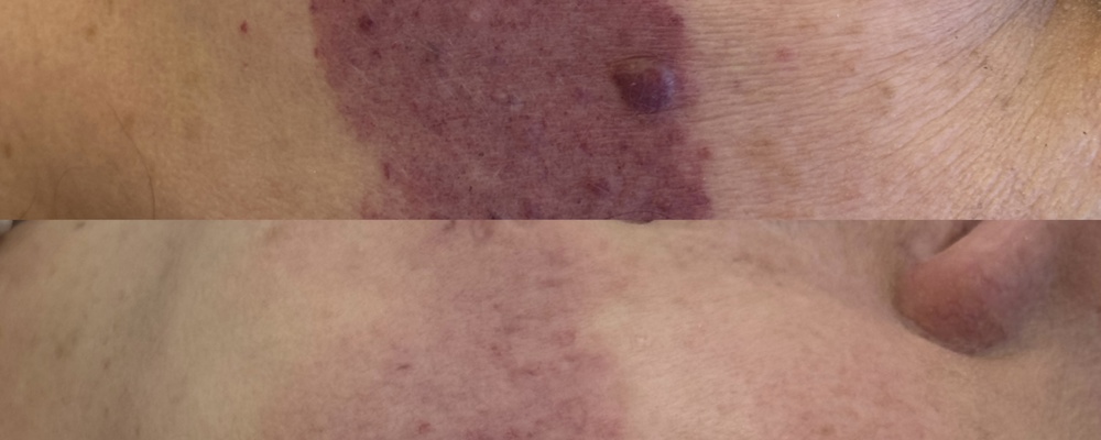 Комплексная коррекция врожденного «винного пятна» 