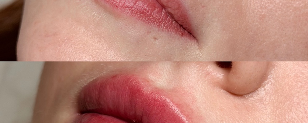 Коррекция и увеличение губ