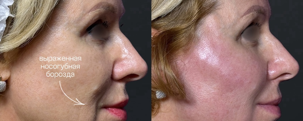 Контурная пластика лица