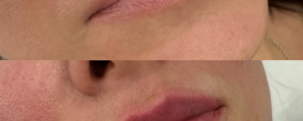 Коррекция и увеличение губ