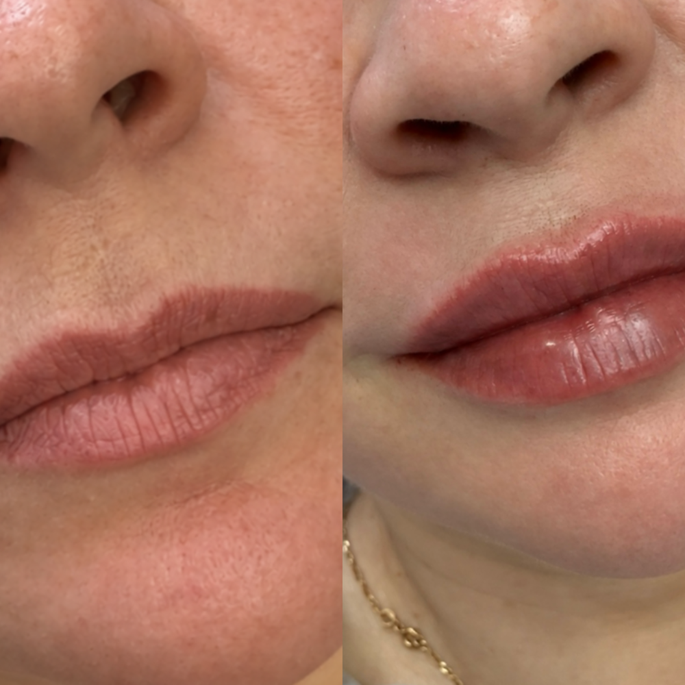 Выразительные губы с Belotero Intense