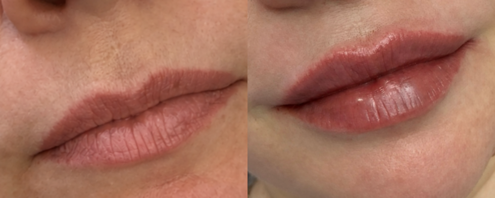 Выразительные губы с Belotero Intense