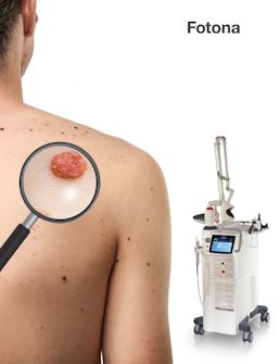 Fotona: удаление новообразований