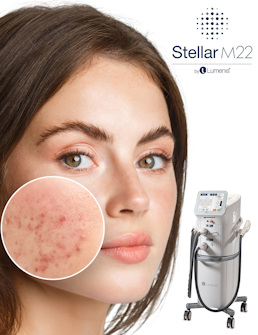 ru;Лечение акне Stellar M22