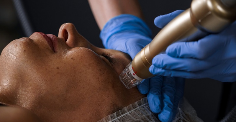 Микроигольчатый RF-лифтинг на аппарате Sylfirm X