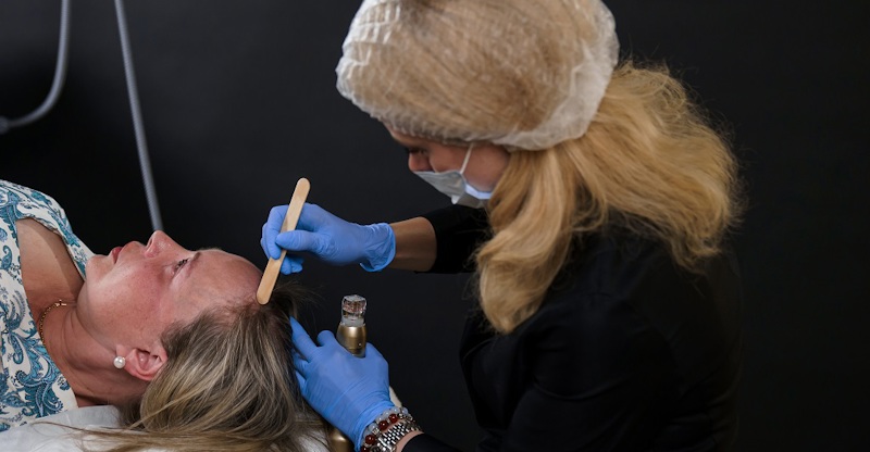 Микроигольчатый RF-лифтинг Sylfirm X в трихологии