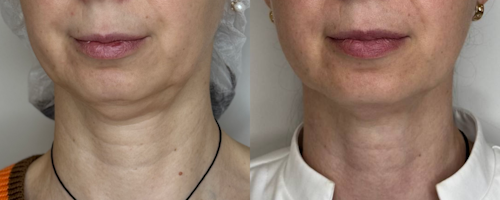 Лазерный лифтинг Endolift