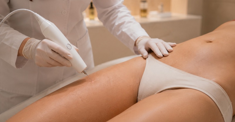 Безоперационная подтяжка тела Endolift