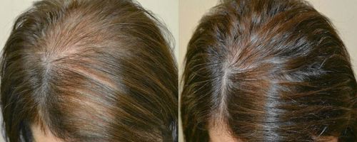 Fotona: лечение выпадения волос