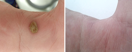 Fotona: удаление новообразований