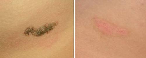 Fotona: удаление новообразований