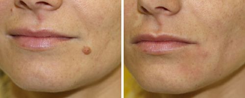 Fotona: удаление новообразований