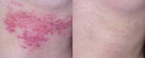 Светодиодная фототерапия Healite II Lutronic