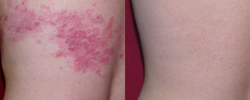 Светодиодная фототерапия Healite II Lutronic