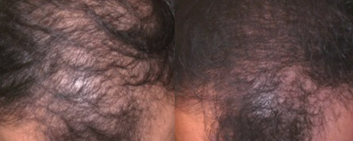 Светодиодная фототерапия Healite II Lutronic