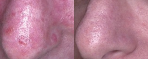 Светодиодная фототерапия Healite II Lutronic
