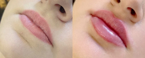 Увеличение и коррекция губ