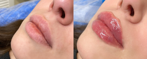 Увеличение и коррекция губ