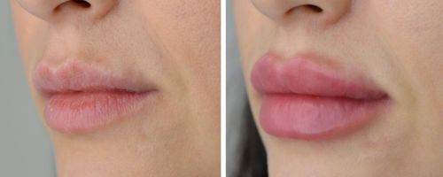 Увеличение и коррекция губ